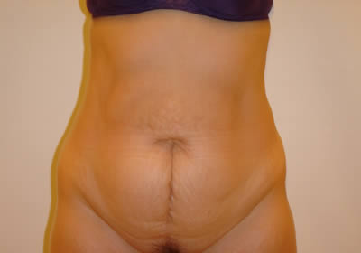 abdominoplasty picture 7 before
