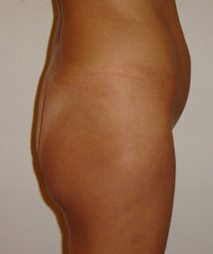 gluteus3