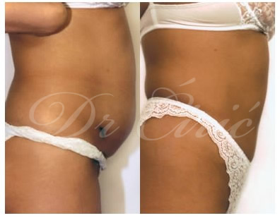 Abdominoplasty - Laser and Classic - Body Surgery - Dr Ciric