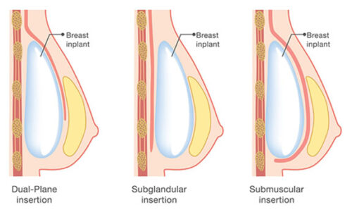 Round vs teardrop breast implants