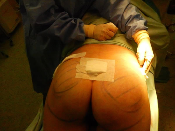 Buttock augmentation and reshaping with own fat tissue - Aesthetic