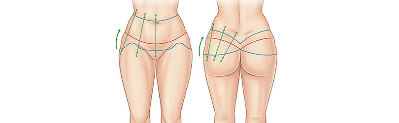 Thigh Lift Surgery: Comparing the Surgical Techniques