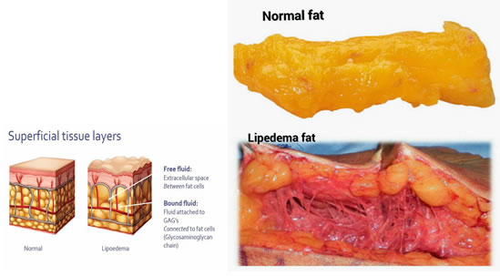LIPOELASTIC on X: Get some basic insights about #lipoedema